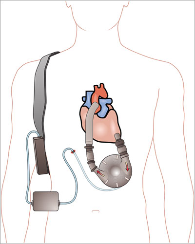 Dispositivo de asistencia ventricular