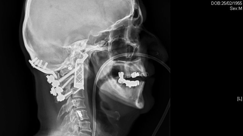 Radiografía del paciente con sus vértebras impresas en 3D