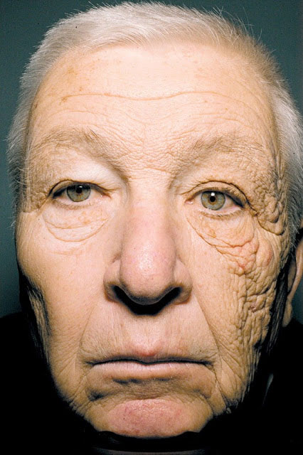 28 años de sol sin protección